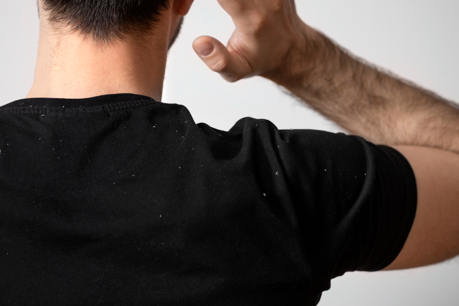 man with dandruff hair